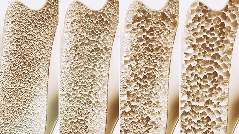 4 examples of bone density